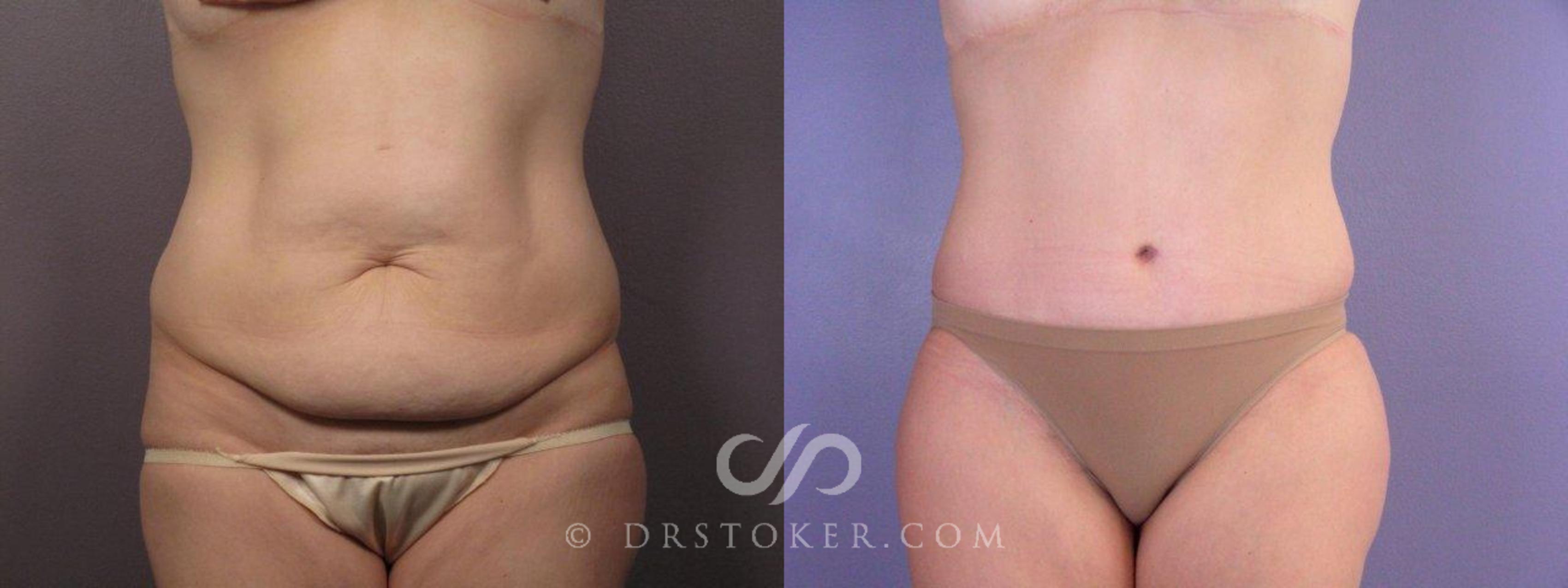 Before & After Tummy Tuck Case 374 View #1 View in Los Angeles, CA