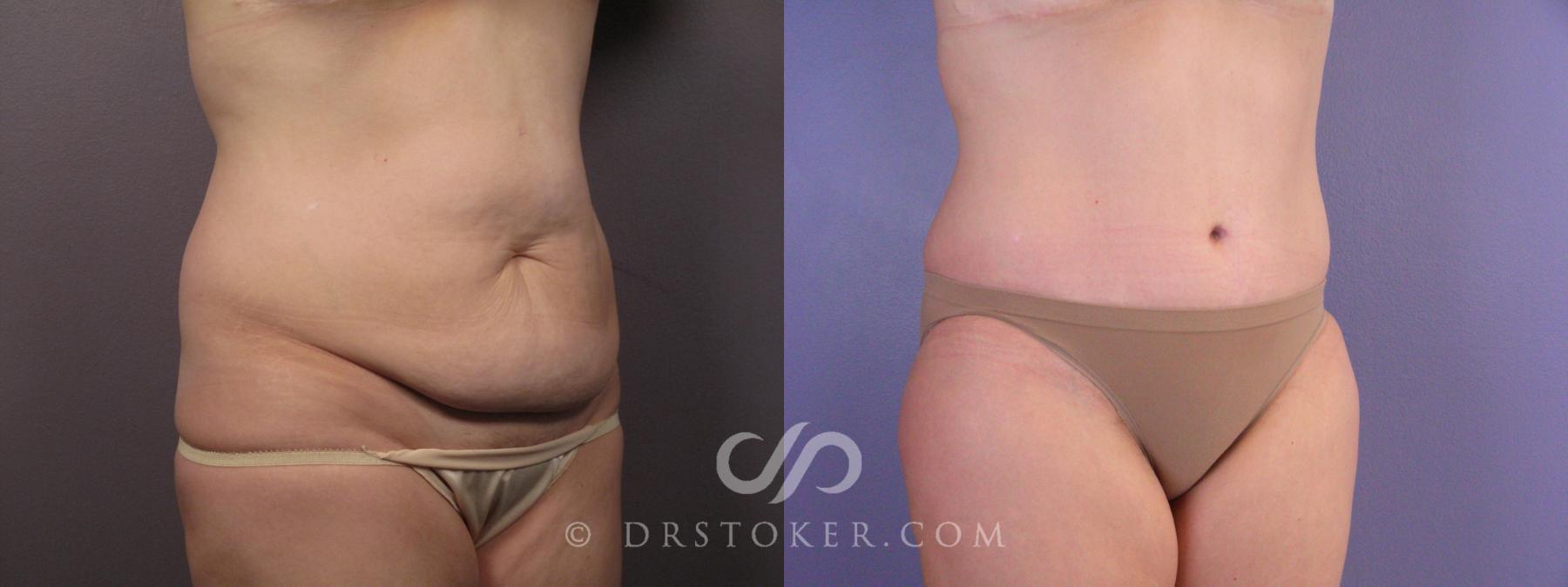 Before & After Tummy Tuck Case 374 View #2 View in Los Angeles, CA