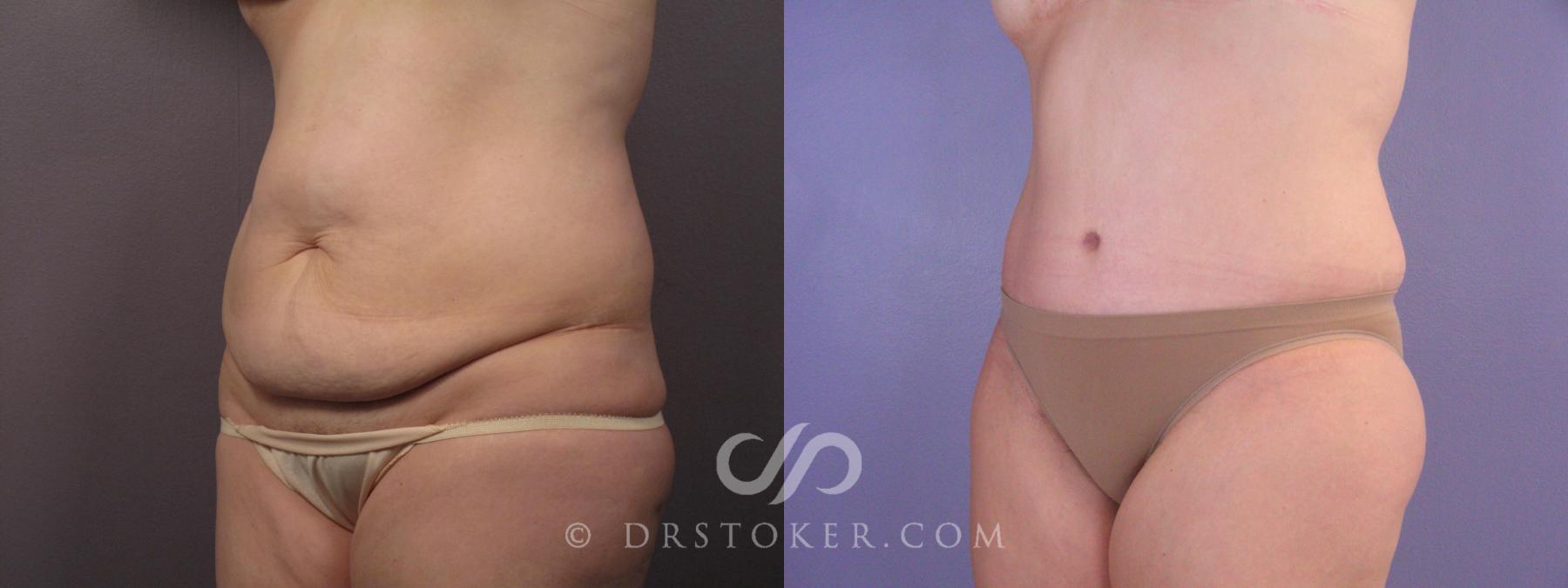 Before & After Tummy Tuck Case 374 View #3 View in Los Angeles, CA