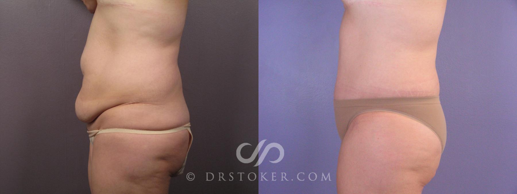 Before & After Tummy Tuck Case 374 View #4 View in Los Angeles, CA