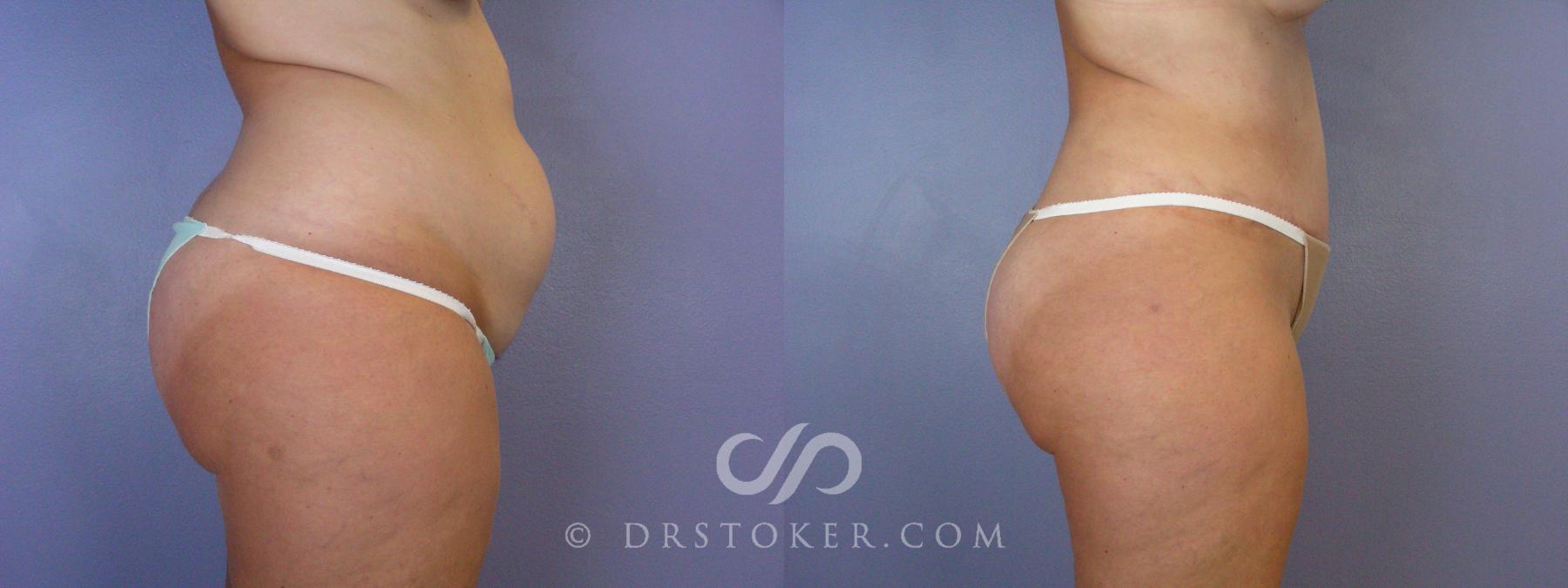 Before & After Tummy Tuck Case 375 View #2 View in Los Angeles, CA