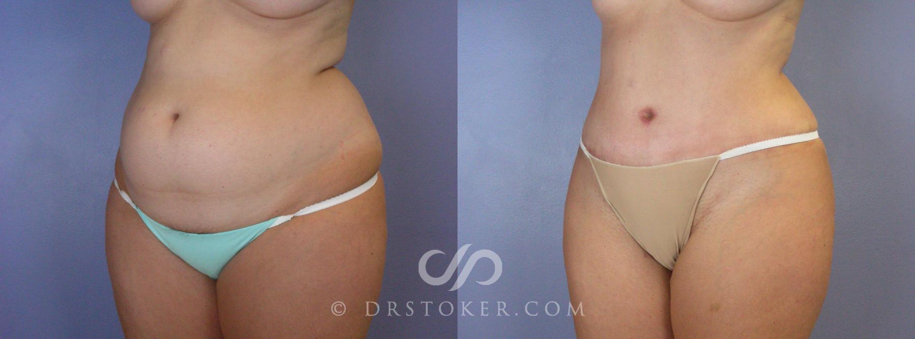 Before & After Tummy Tuck Case 375 View #4 View in Los Angeles, CA