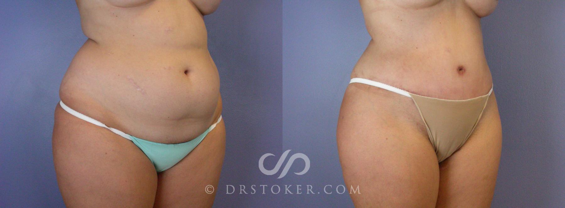 Before & After Tummy Tuck Case 375 View #5 View in Los Angeles, CA