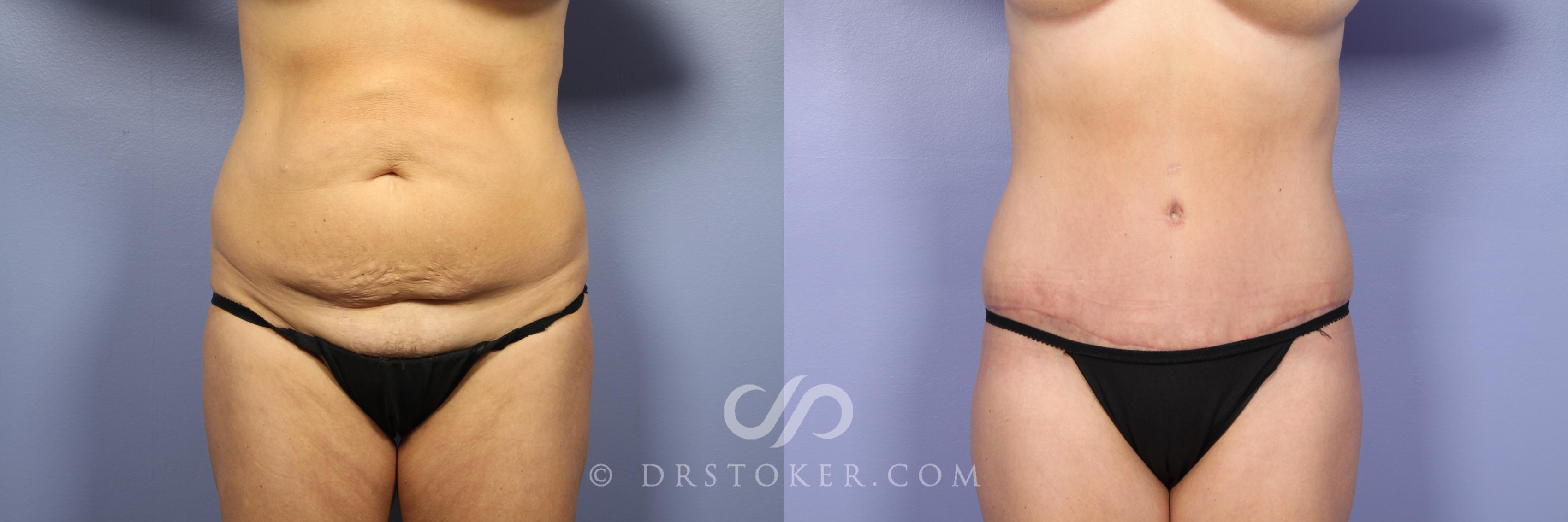 Before & After Tummy Tuck Case 376 View #1 View in Los Angeles, CA