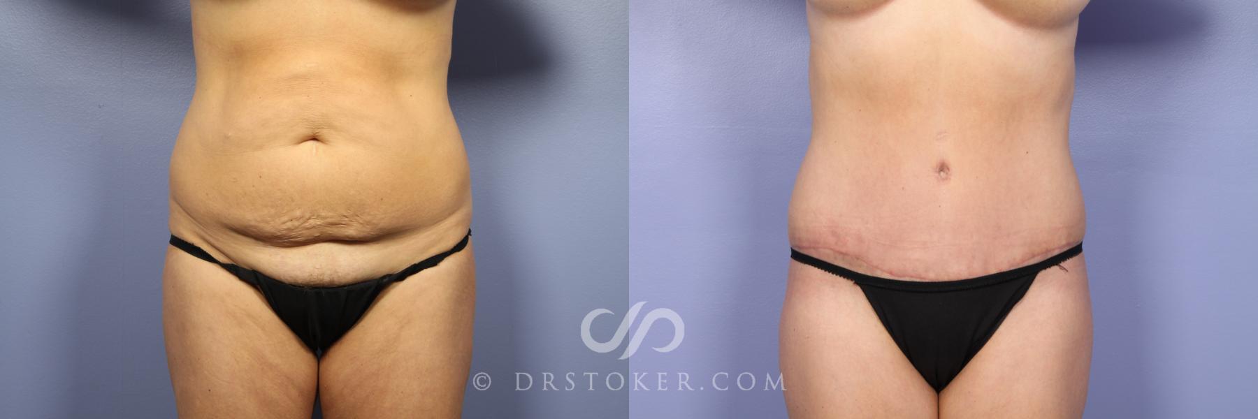 Before & After Tummy Tuck Case 376 View #1 View in Los Angeles, CA
