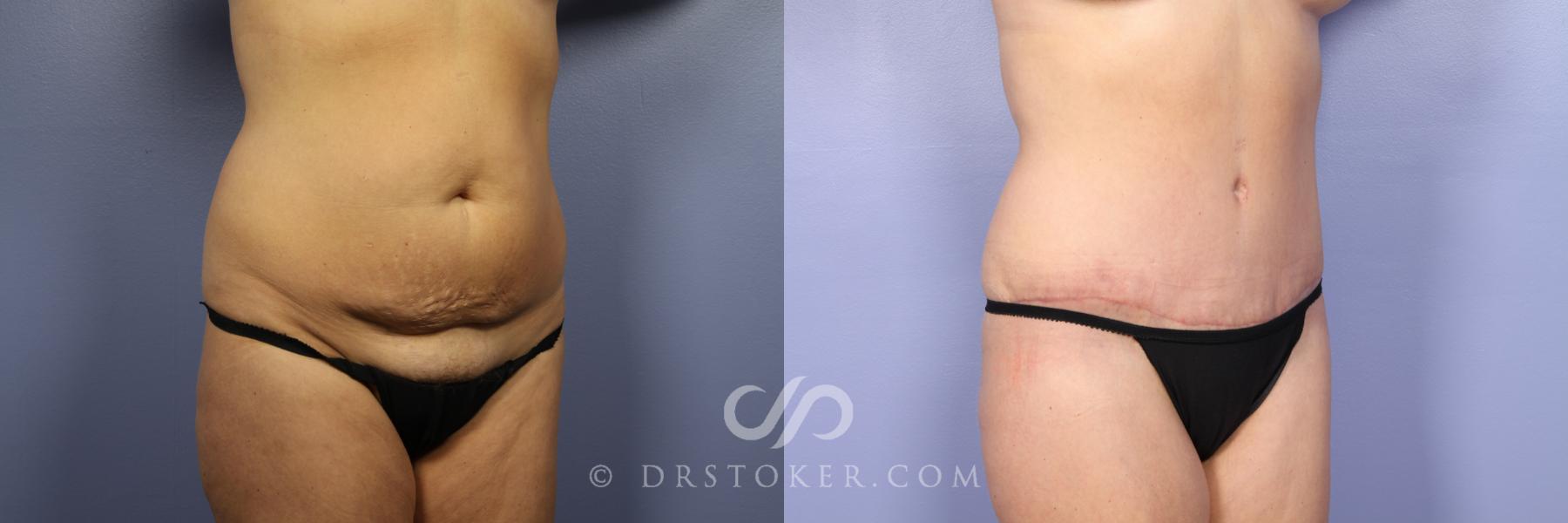 Before & After Tummy Tuck Case 376 View #2 View in Los Angeles, CA