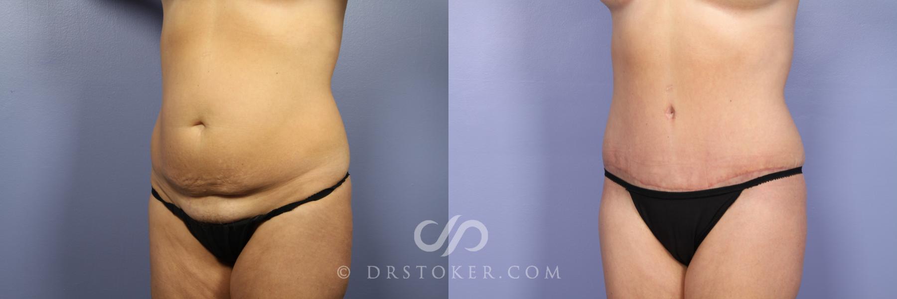Before & After Tummy Tuck Case 376 View #5 View in Los Angeles, CA