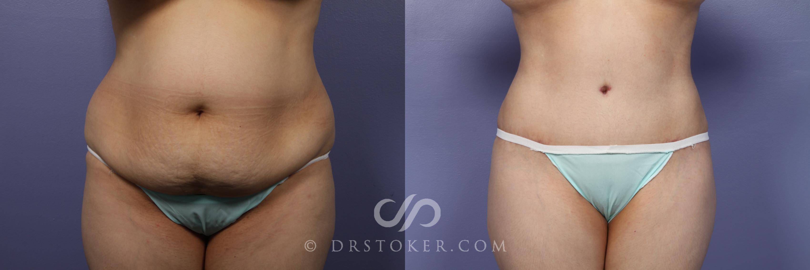 Before & After Tummy Tuck Case 394 View #1 View in Los Angeles, CA