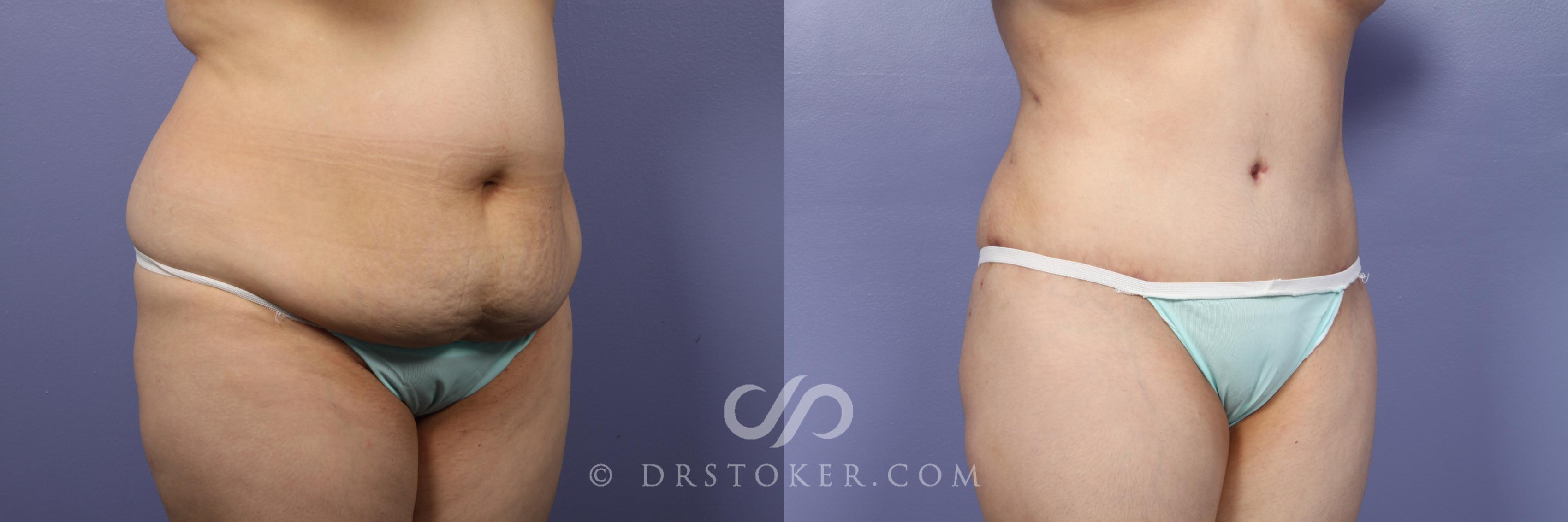 Before & After Tummy Tuck Case 394 View #2 View in Los Angeles, CA