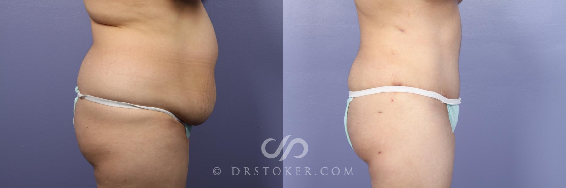 Before & After Tummy Tuck Case 394 View #3 View in Los Angeles, CA