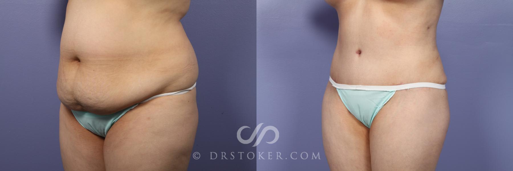 Before & After Tummy Tuck Case 394 View #4 View in Los Angeles, CA