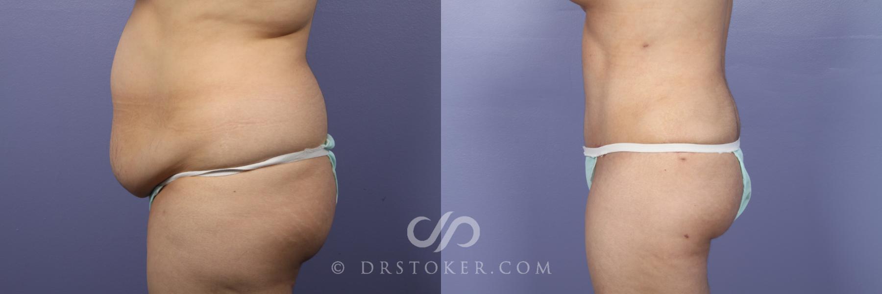 Before & After Tummy Tuck Case 394 View #5 View in Los Angeles, CA