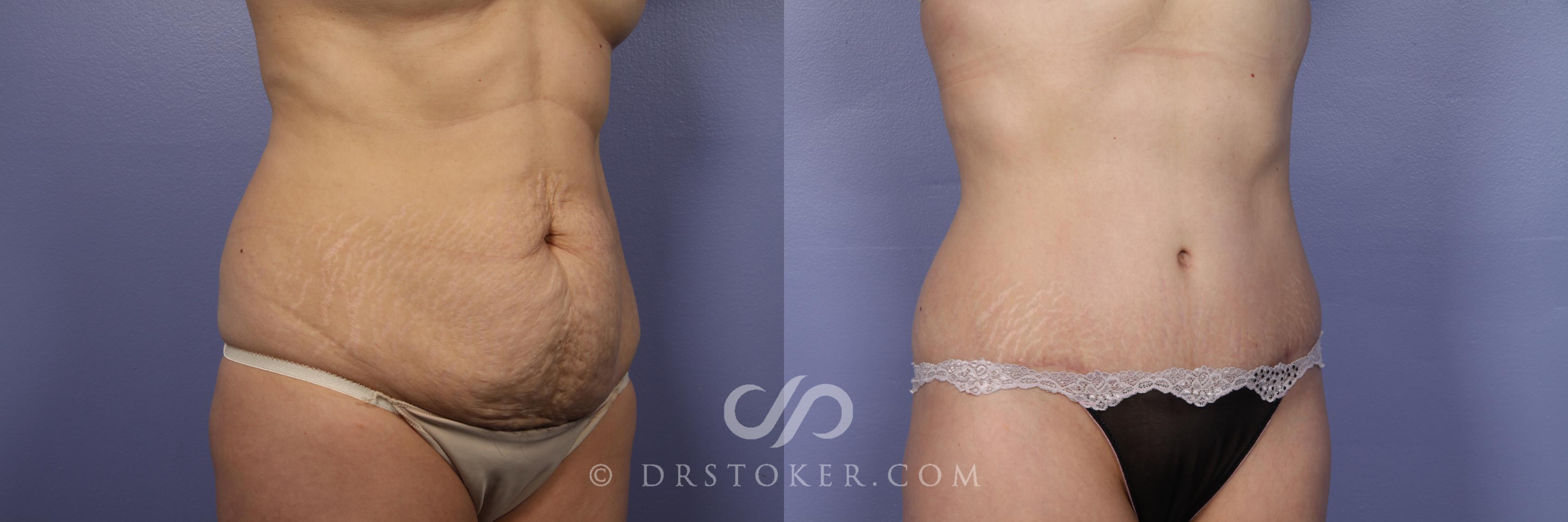 Before & After Tummy Tuck Case 396 View #2 View in Los Angeles, CA