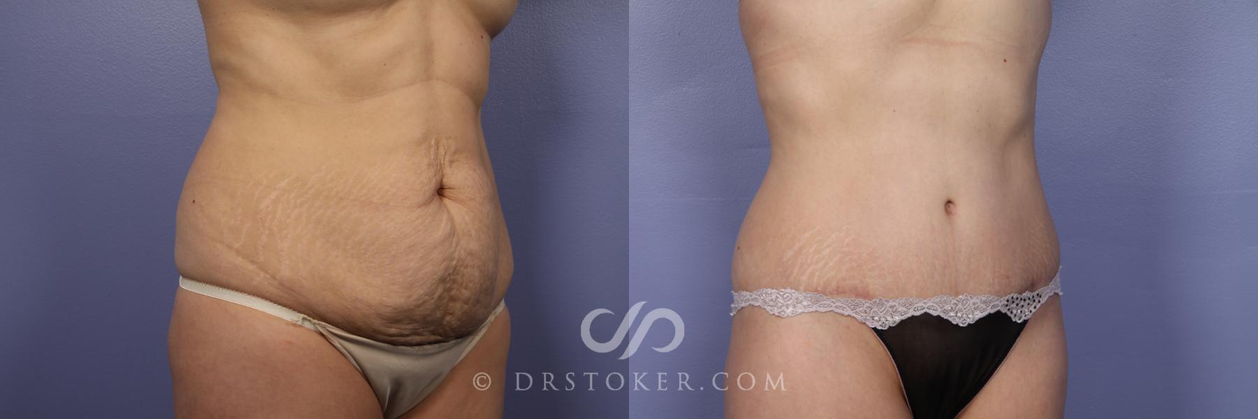 Before & After Tummy Tuck Case 396 View #2 View in Los Angeles, CA