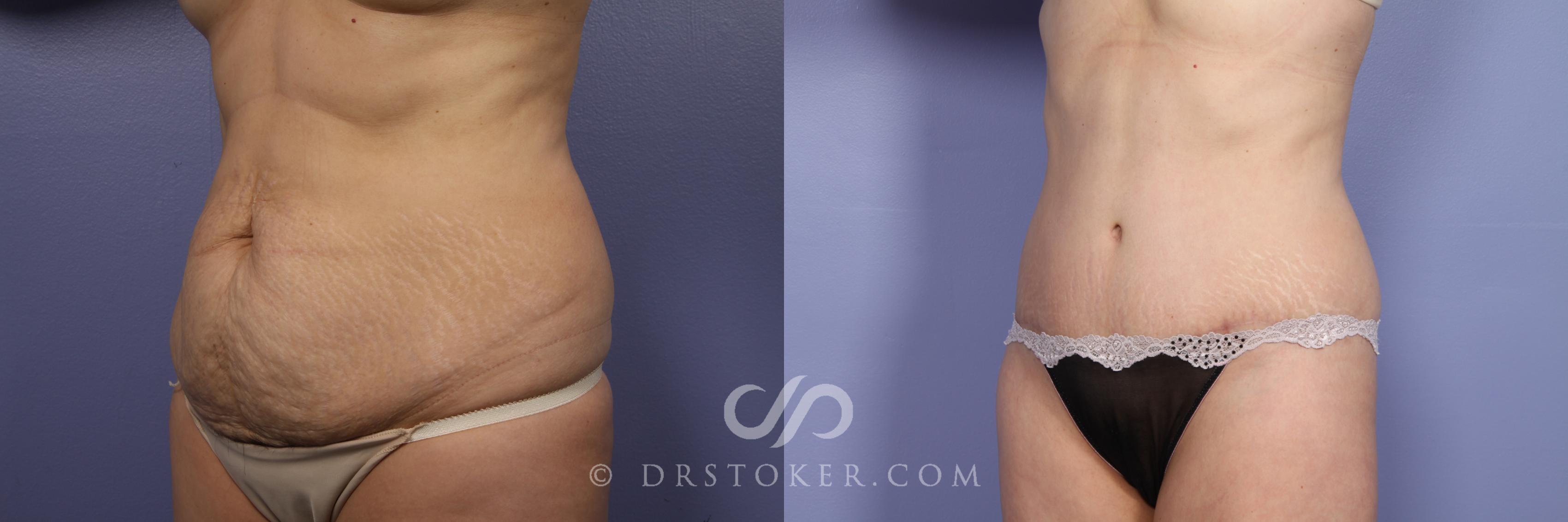 Before & After Tummy Tuck Case 396 View #4 View in Los Angeles, CA