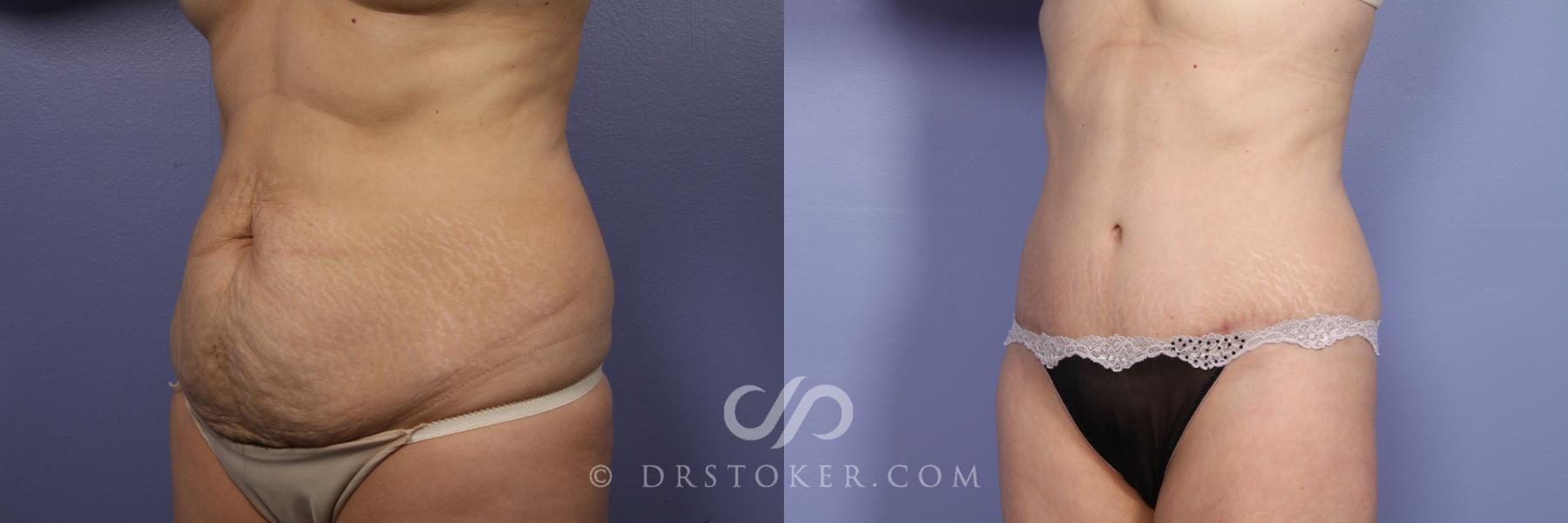 Before & After Tummy Tuck Case 396 View #4 View in Los Angeles, CA