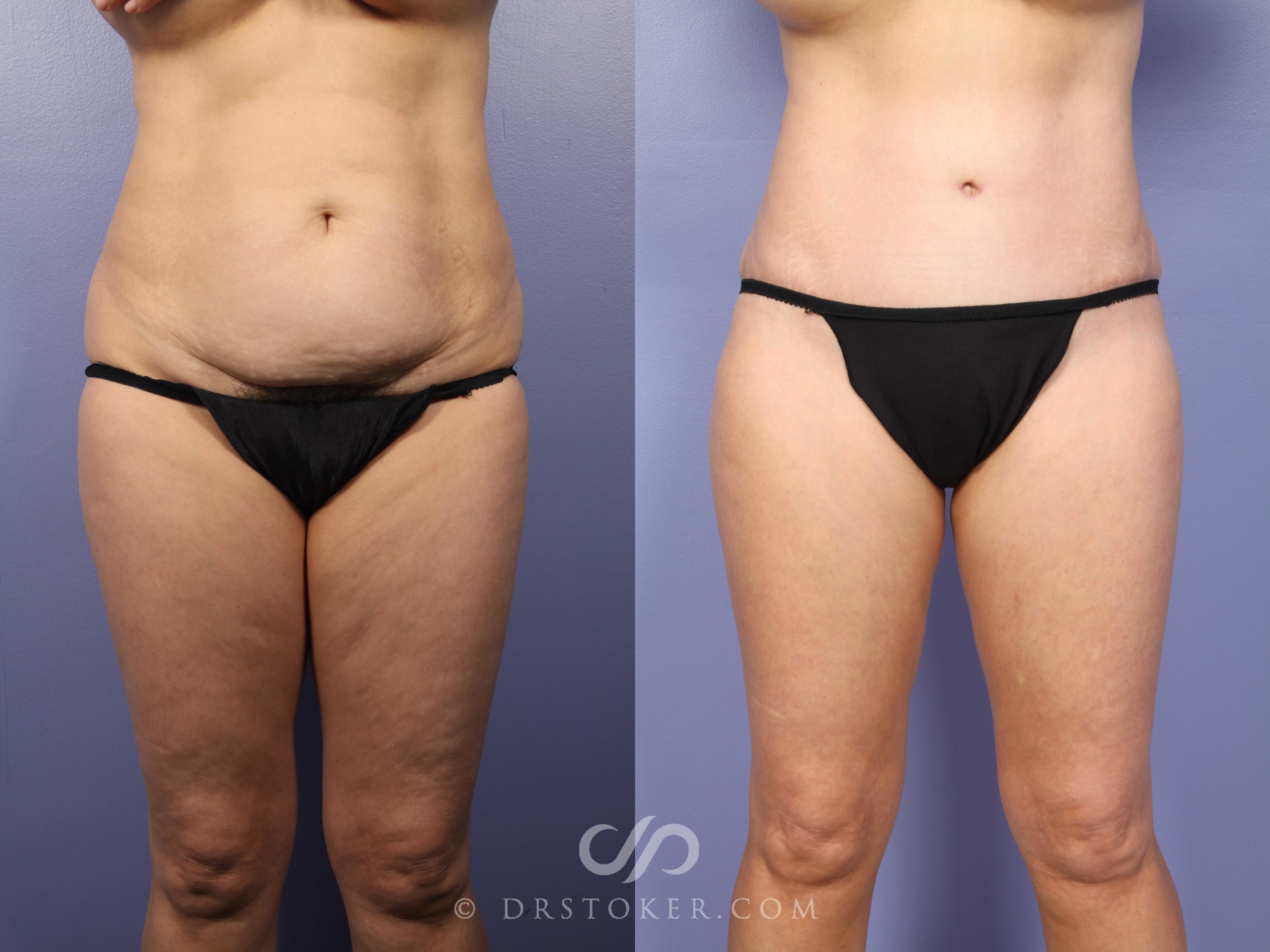 Before & After Tummy Tuck Case 397 View #1 View in Los Angeles, CA