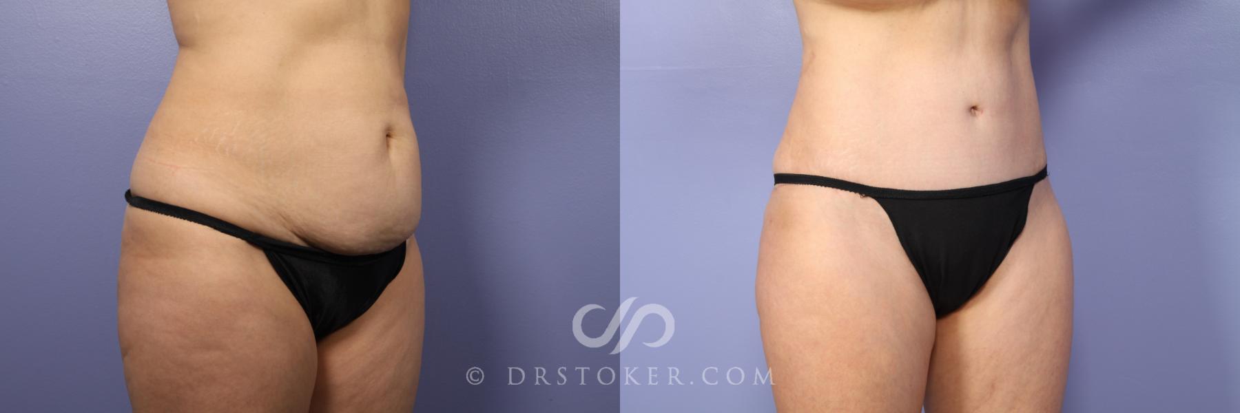 Before & After Tummy Tuck Case 397 View #10 View in Los Angeles, CA