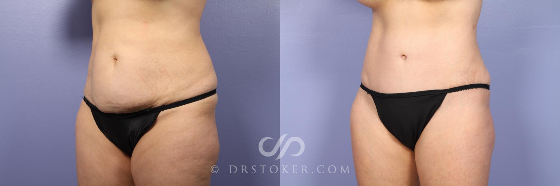 Before & After Tummy Tuck Case 397 View #11 View in Los Angeles, CA