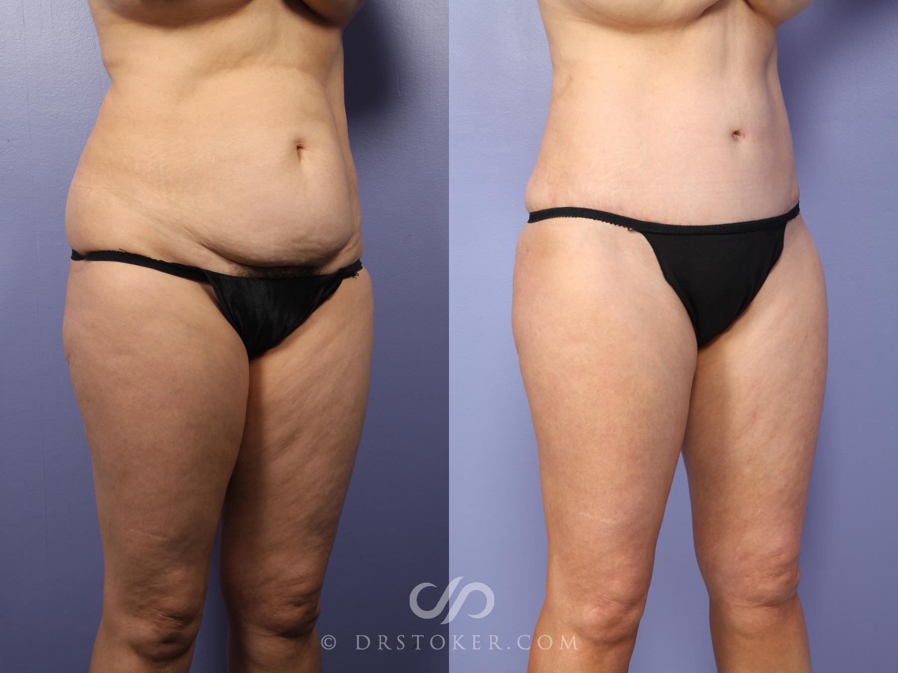 Before & After Tummy Tuck Case 397 View #2 View in Los Angeles, CA