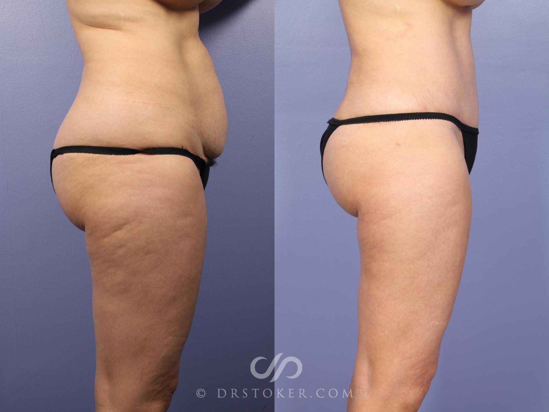 Before & After Tummy Tuck Case 397 View #3 View in Los Angeles, CA