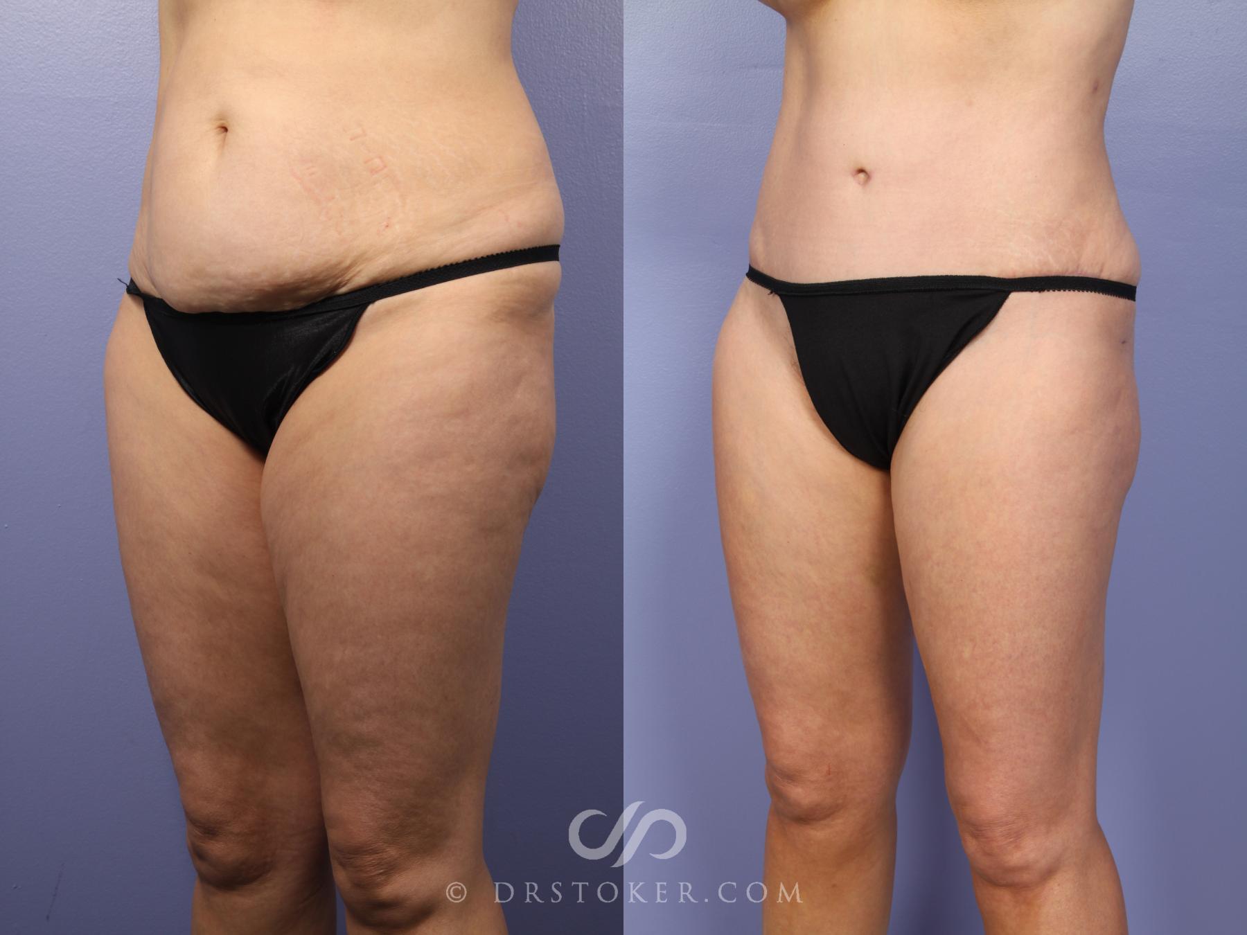 Before & After Tummy Tuck Case 397 View #4 View in Los Angeles, CA