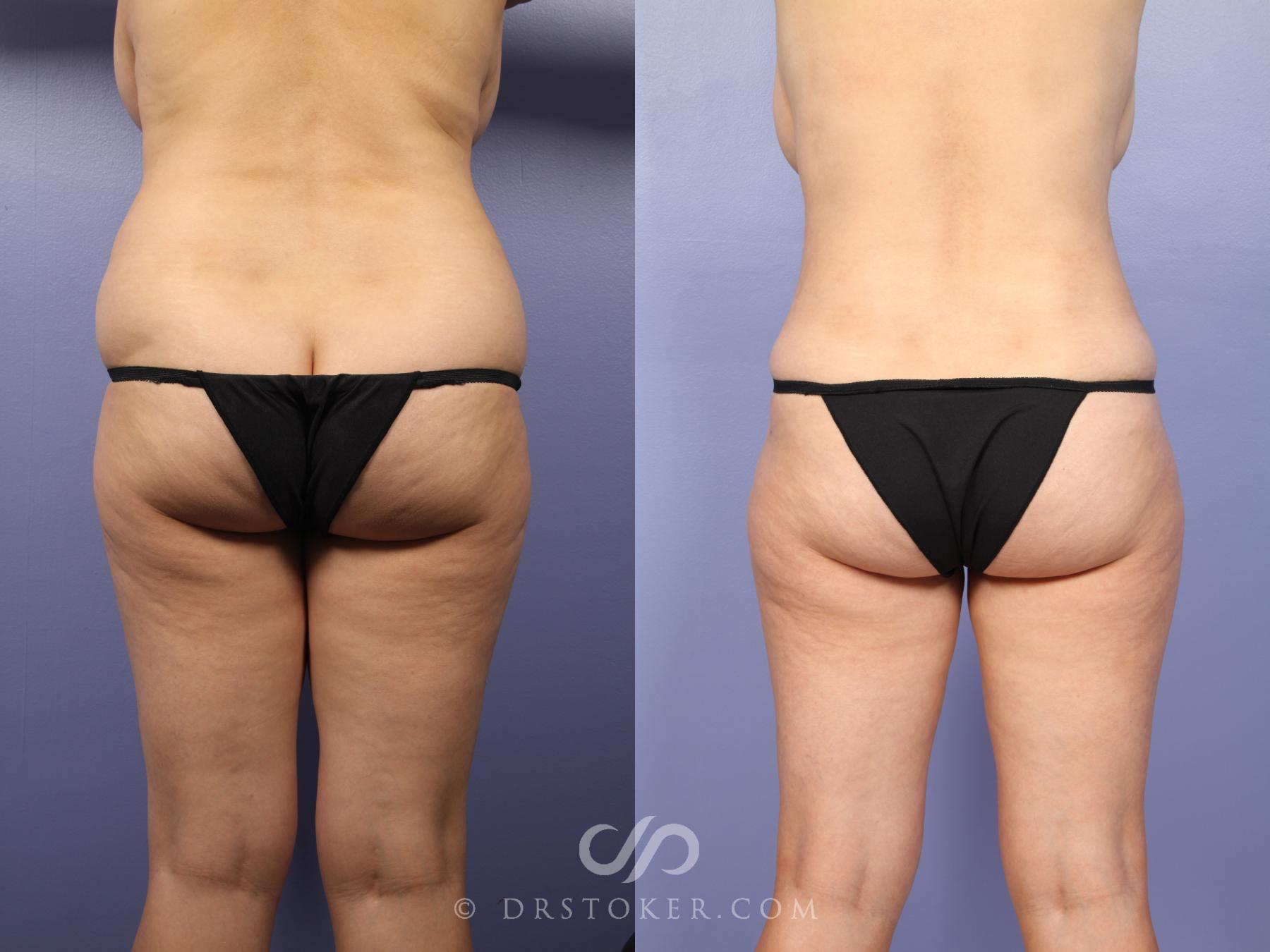 Before & After Tummy Tuck Case 397 View #5 View in Los Angeles, CA