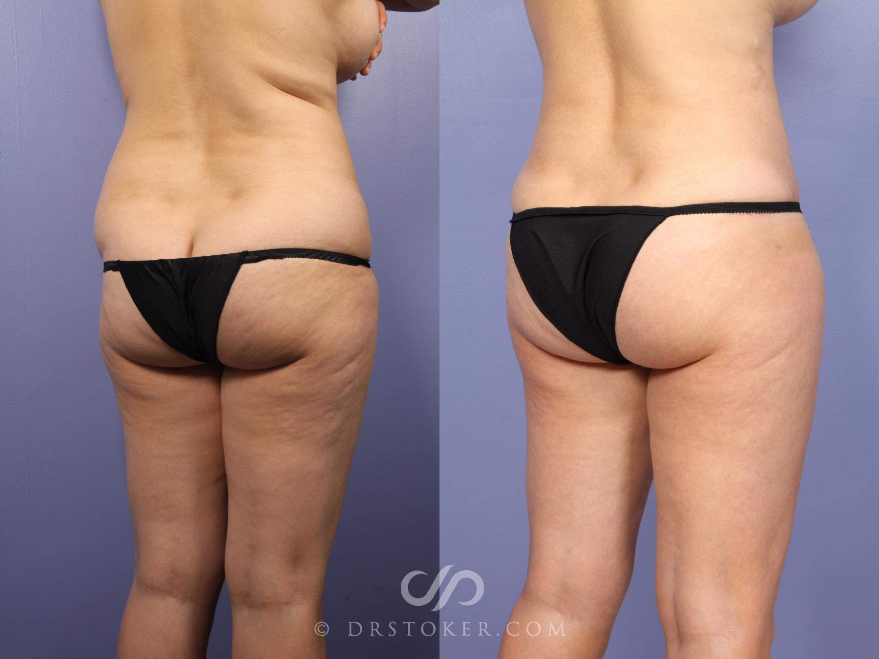 Before & After Tummy Tuck Case 397 View #6 View in Los Angeles, CA