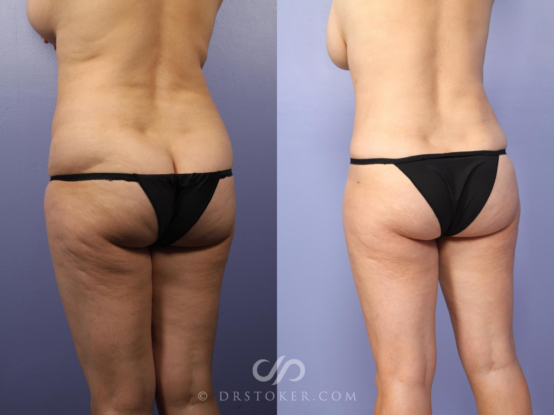 Before & After Tummy Tuck Case 397 View #7 View in Los Angeles, CA