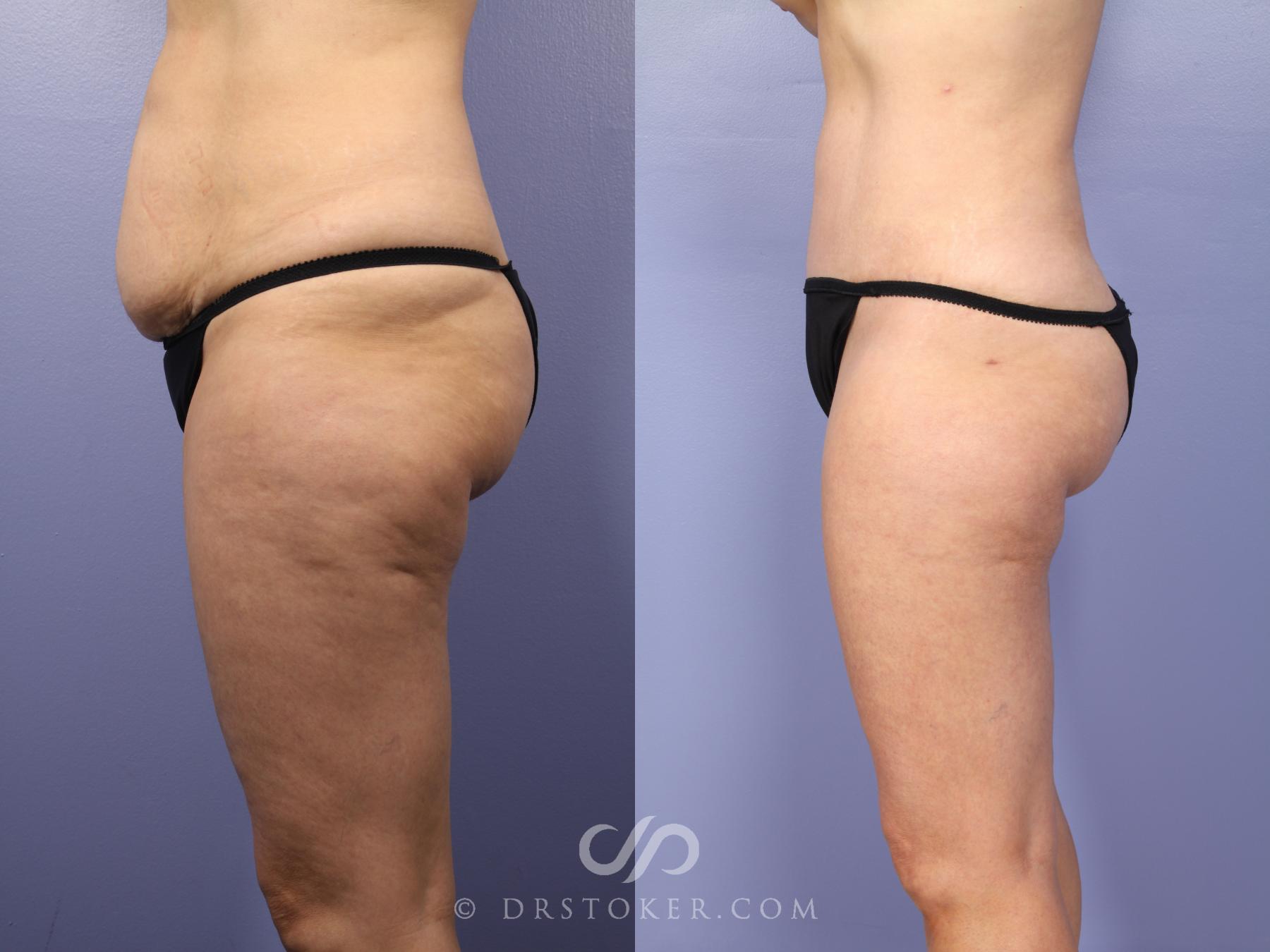 Before & After Tummy Tuck Case 397 View #8 View in Los Angeles, CA