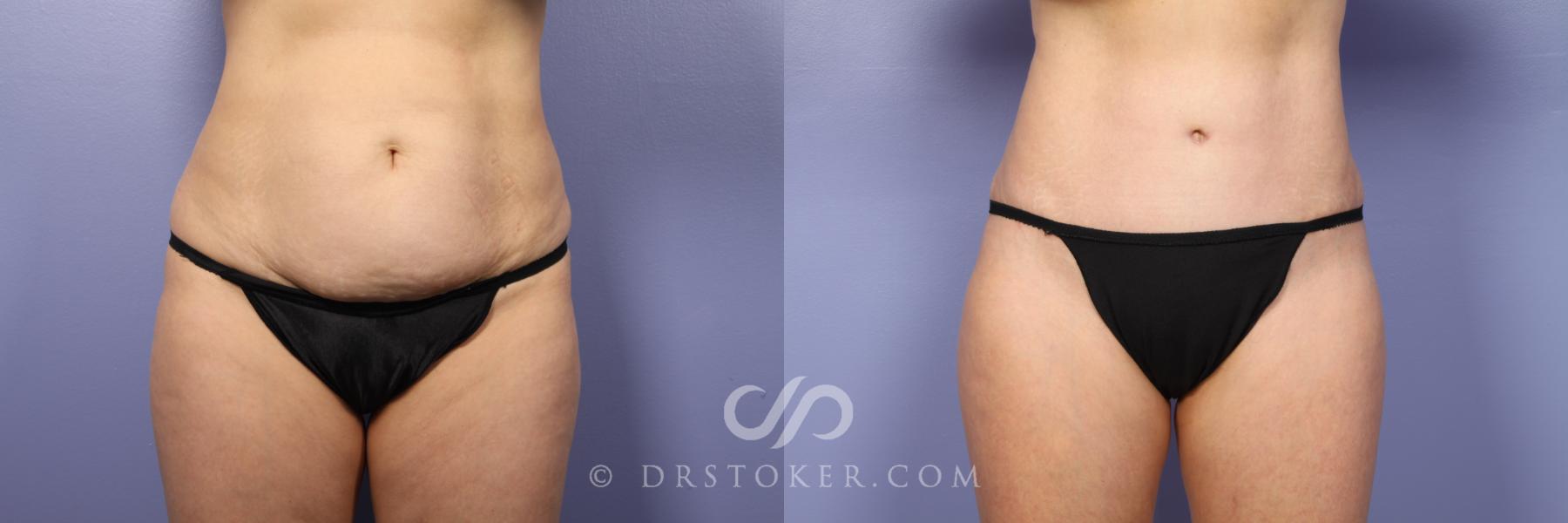 Before & After Tummy Tuck Case 397 View #9 View in Los Angeles, CA