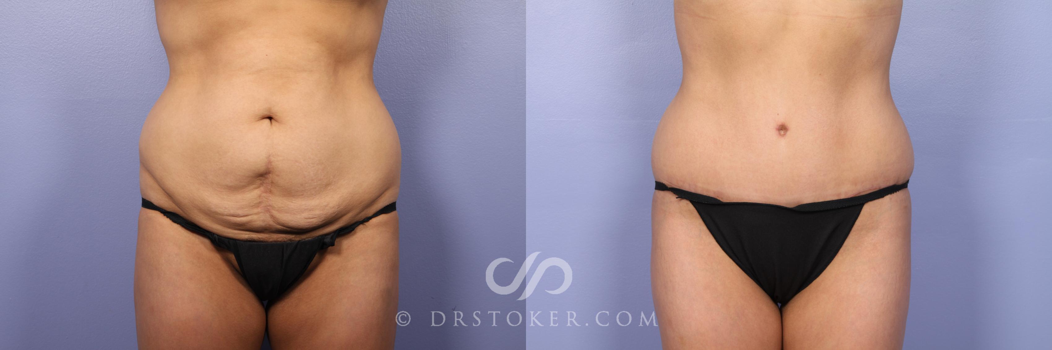Before & After Tummy Tuck Case 399 View #1 View in Los Angeles, CA