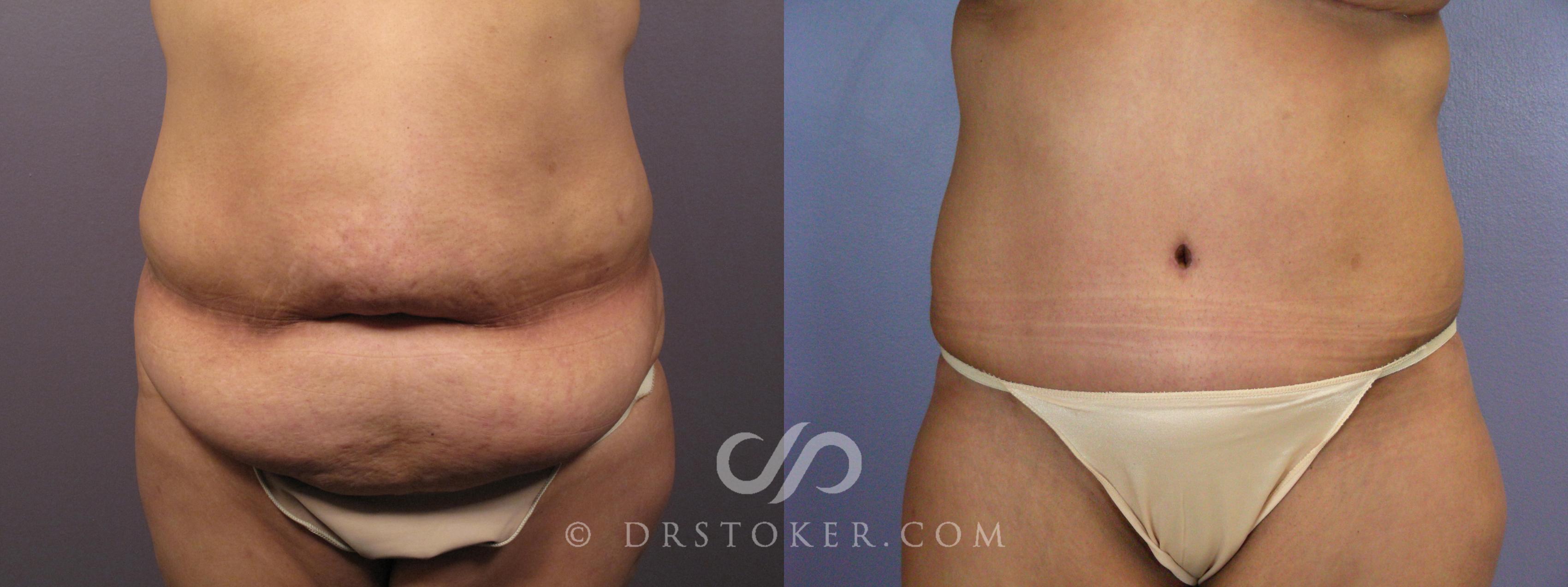 Before & After Tummy Tuck Case 400 View #1 View in Los Angeles, CA