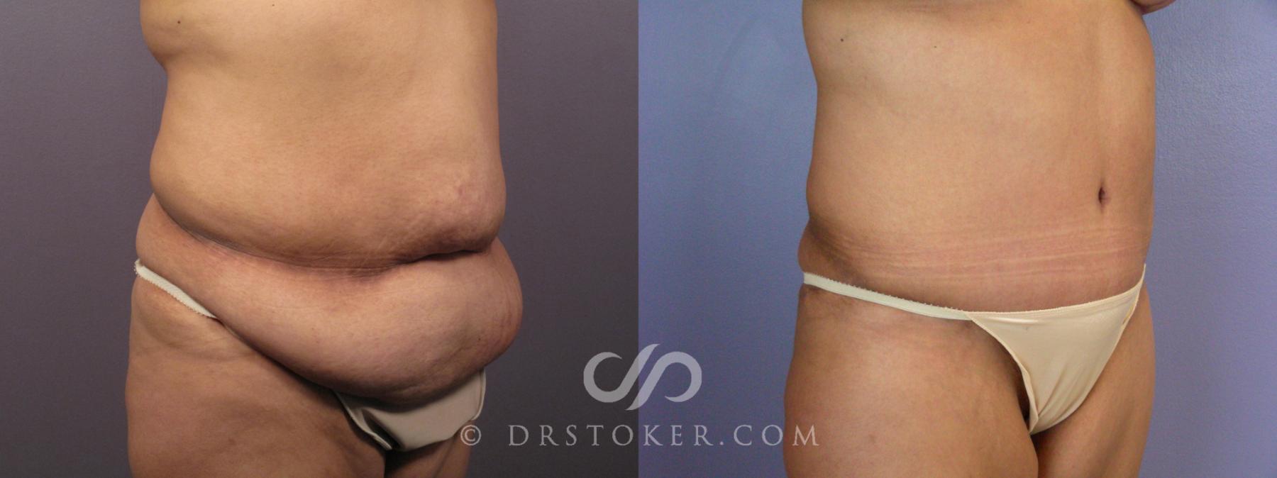 Before & After Tummy Tuck Case 400 View #2 View in Los Angeles, CA
