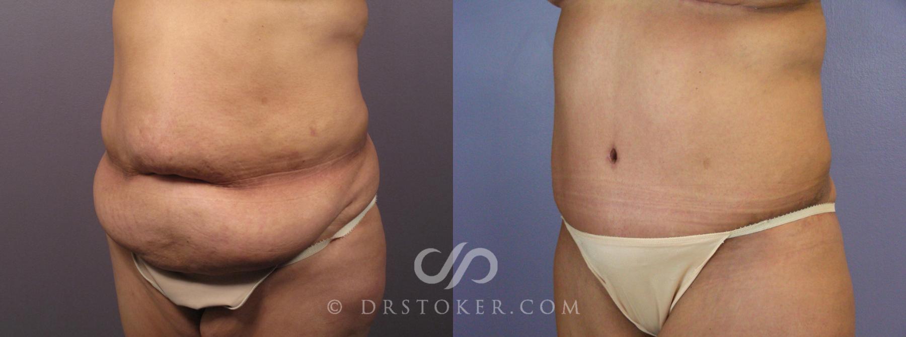 Before & After Tummy Tuck Case 400 View #3 View in Los Angeles, CA