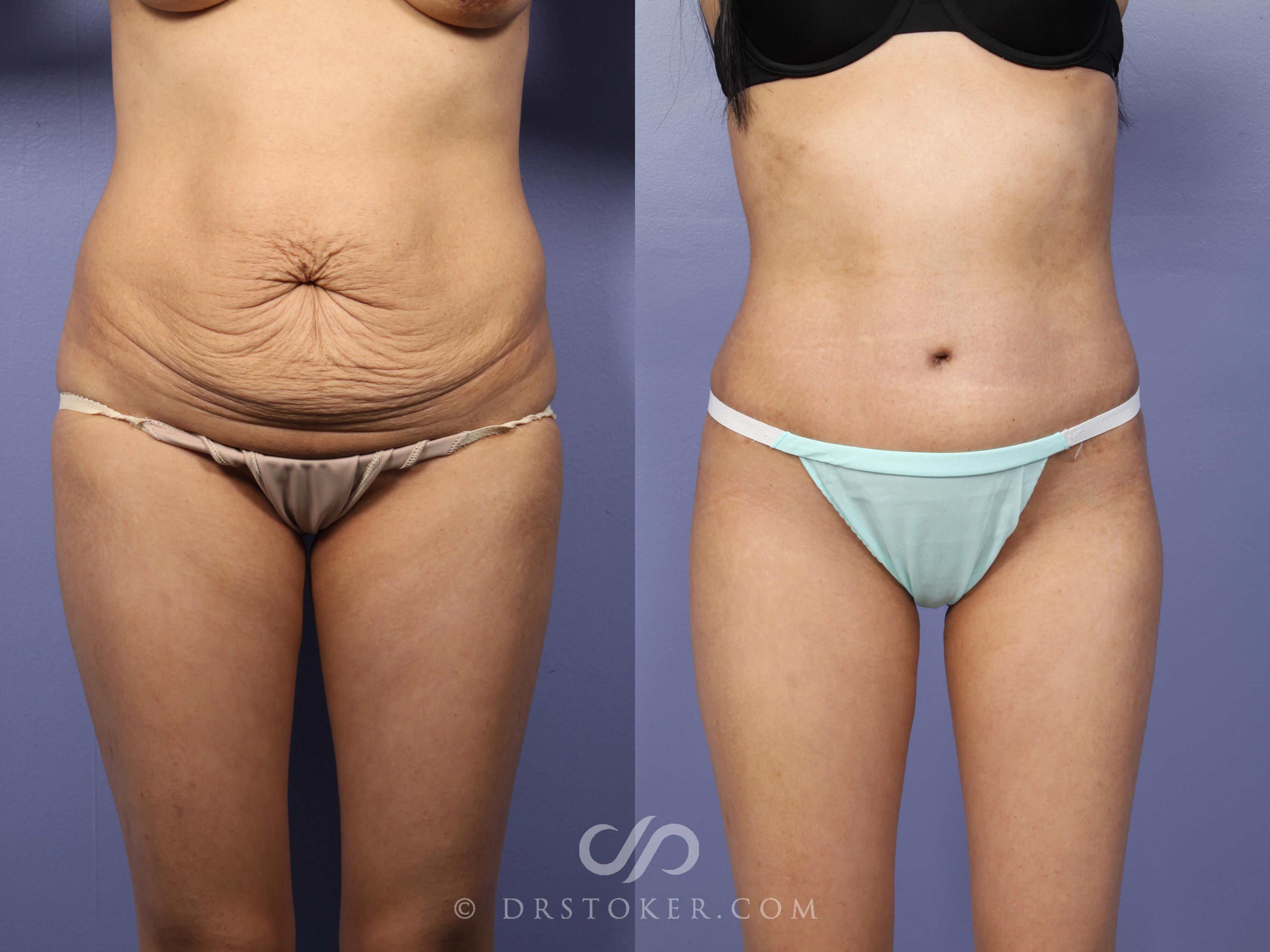 Before & After Tummy Tuck Case 436 View #1 View in Los Angeles, CA