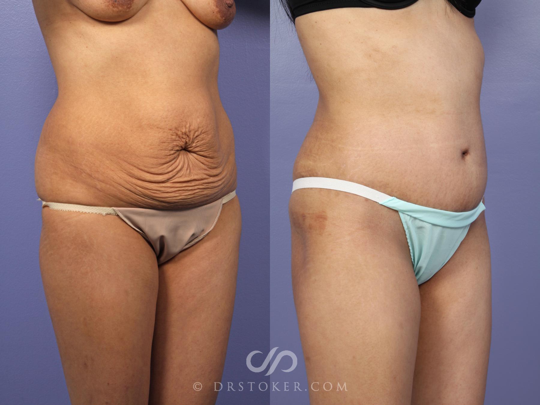 Before & After Tummy Tuck Case 436 View #2 View in Los Angeles, CA