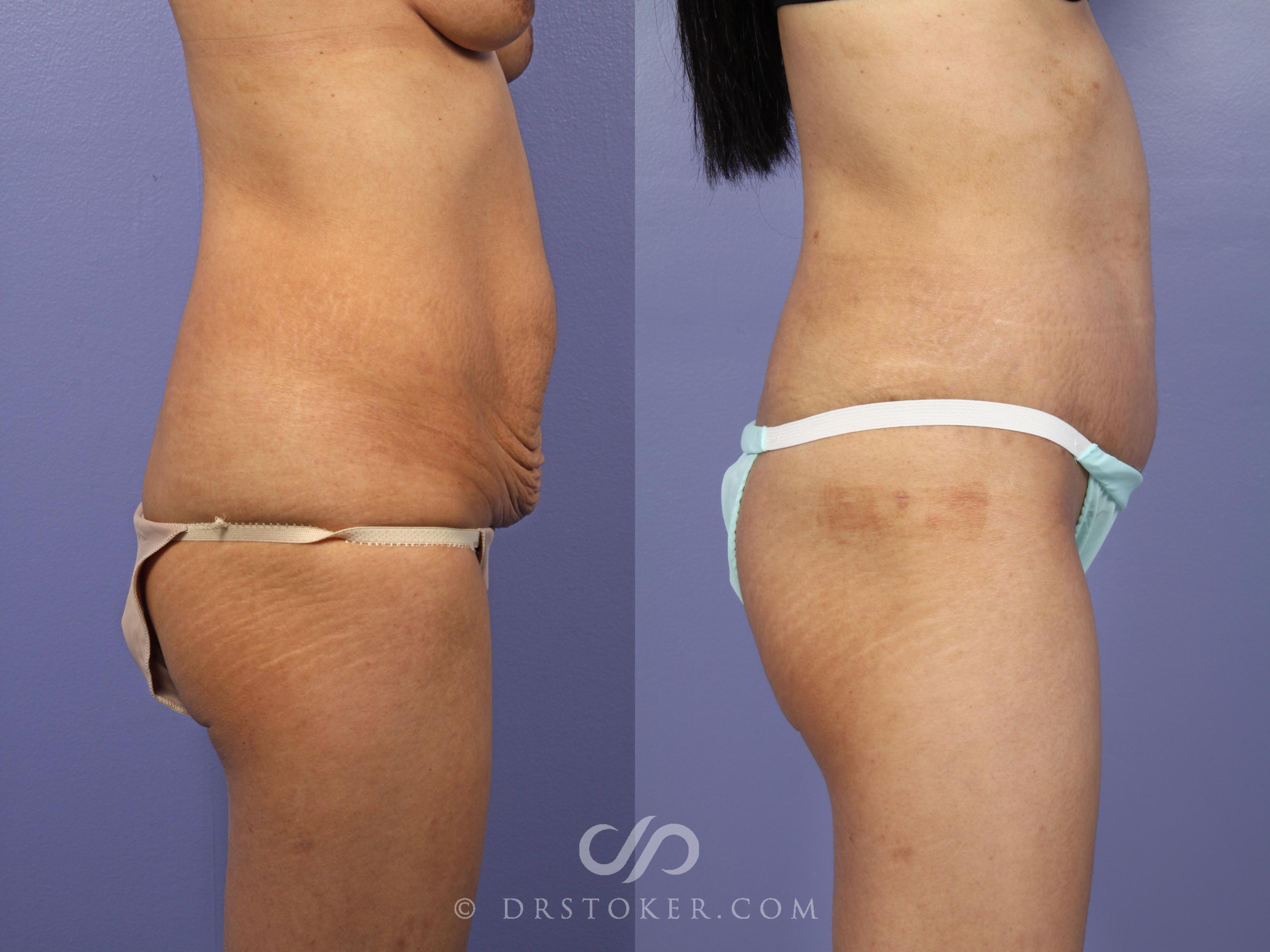 Before & After Tummy Tuck Case 436 View #3 View in Los Angeles, CA