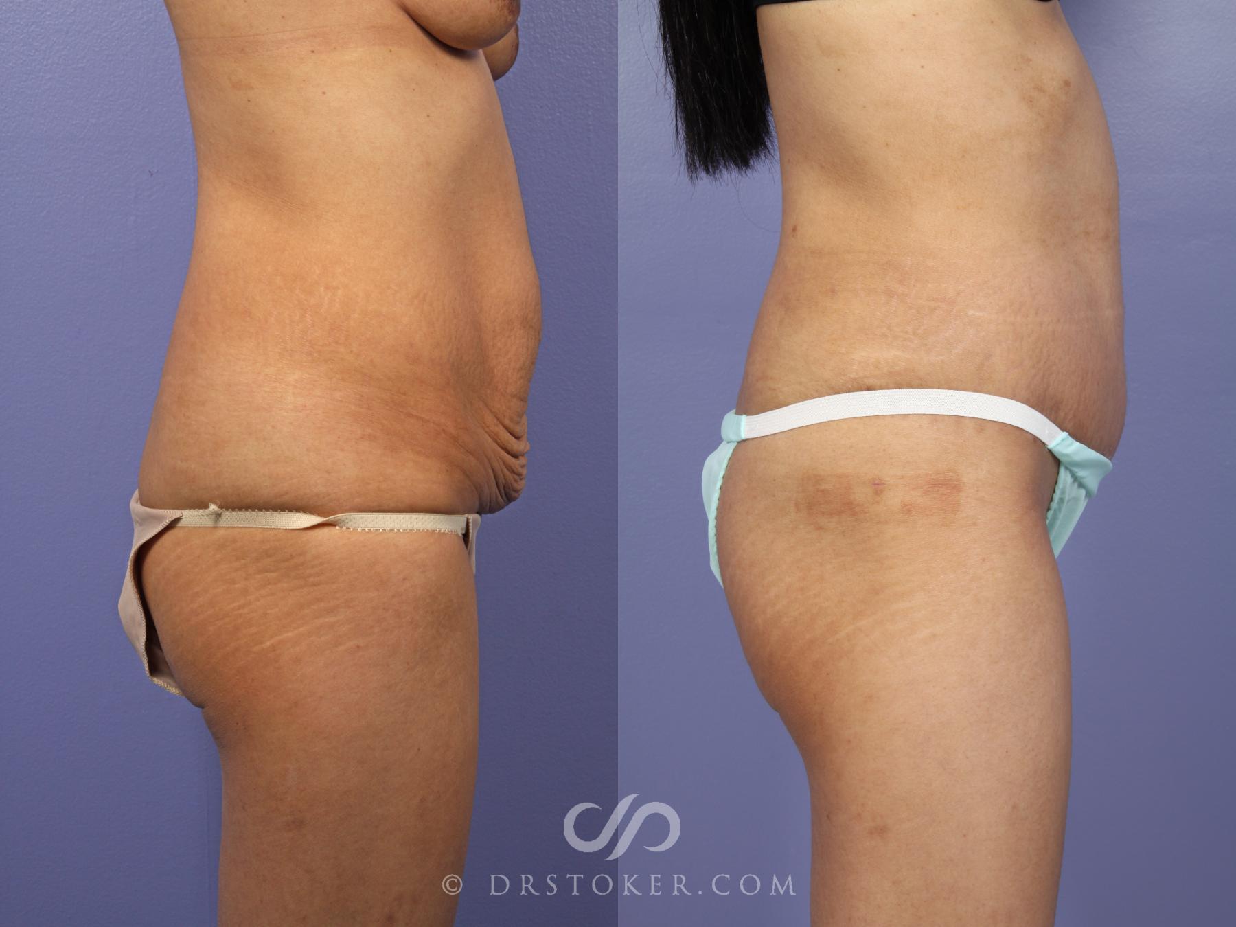 Before & After Tummy Tuck Case 436 View #3 View in Los Angeles, CA