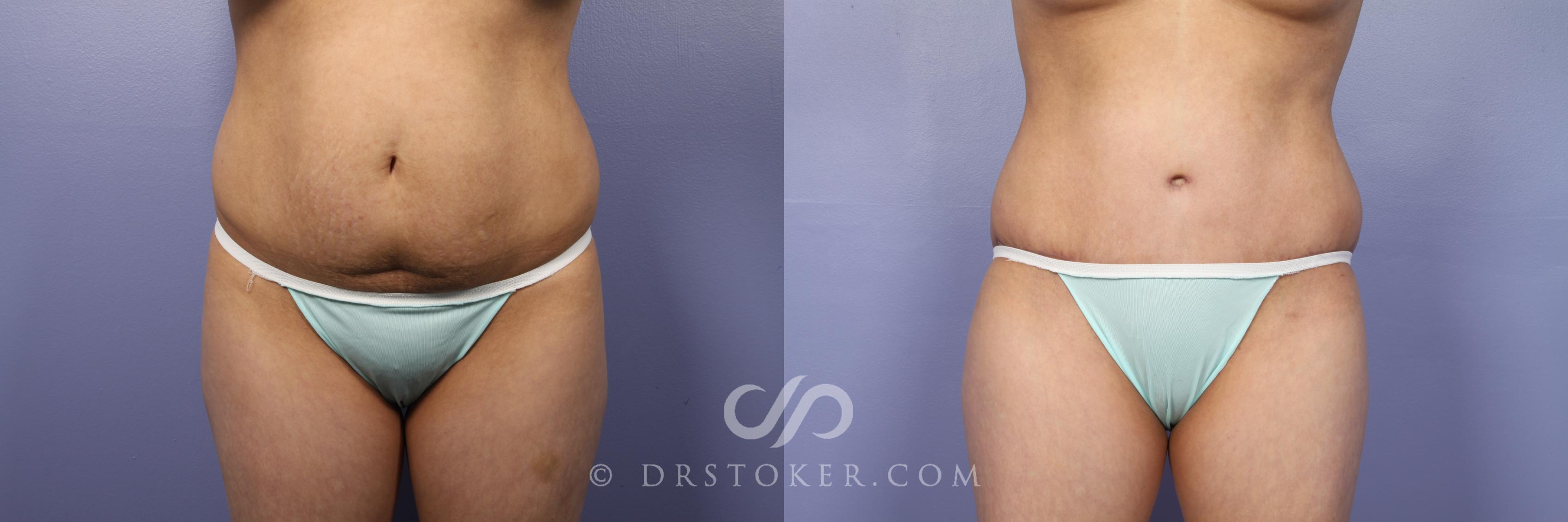 Before & After Tummy Tuck Case 438 View #1 View in Los Angeles, CA