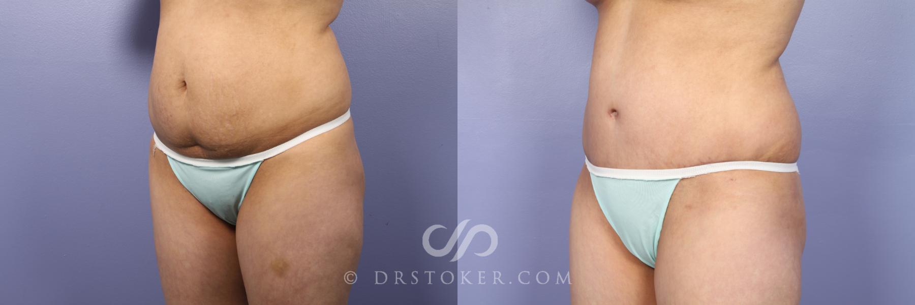 Before & After Tummy Tuck Case 438 View #2 View in Los Angeles, CA