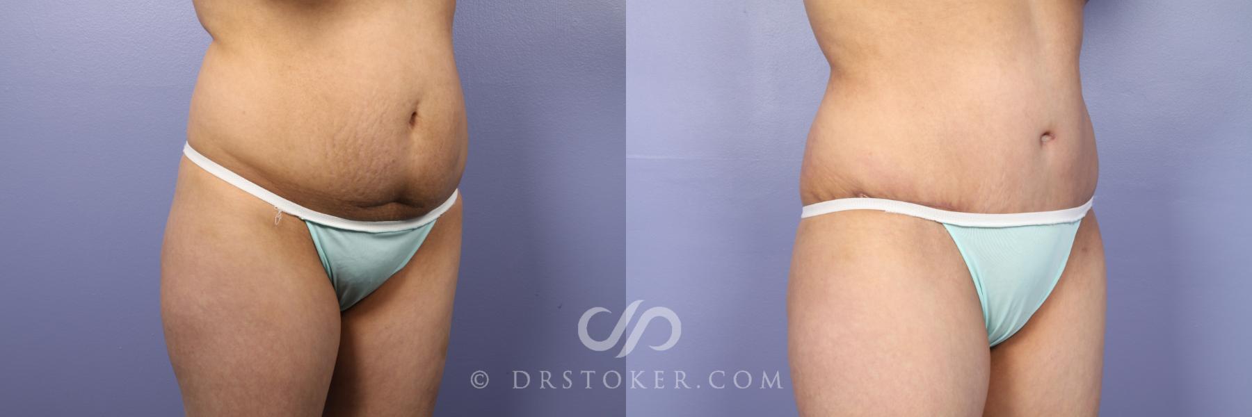 Before & After Tummy Tuck Case 438 View #3 View in Los Angeles, CA