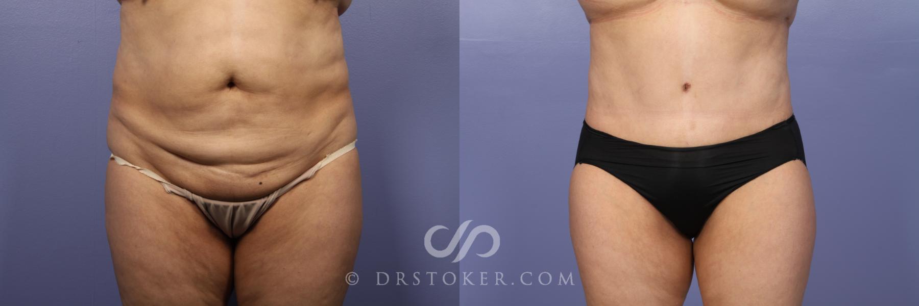 Before & After Liposuction Case 439 View #1 View in Los Angeles, CA