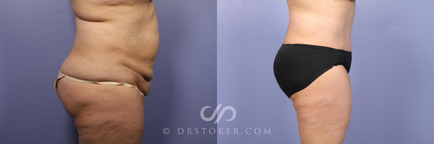 Before & After Liposuction Case 439 View #3 View in Los Angeles, CA