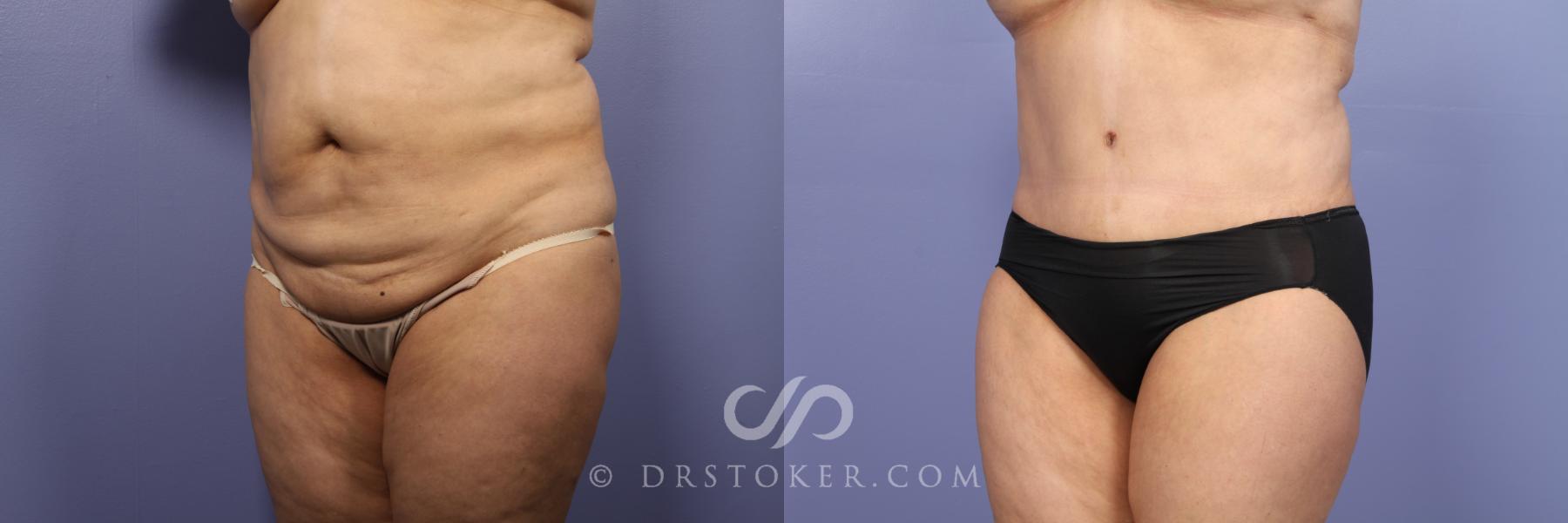 Before & After Liposuction Case 439 View #4 View in Los Angeles, CA