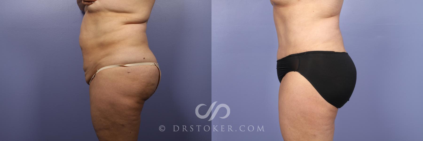 Before & After Tummy Tuck Case 439 View #5 View in Los Angeles, CA