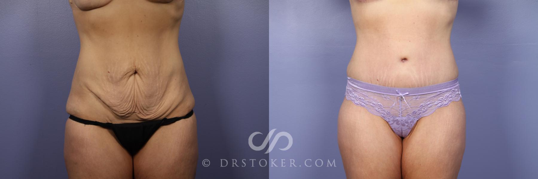 Before & After After Weight Loss Case 440 View #1 View in Los Angeles, CA