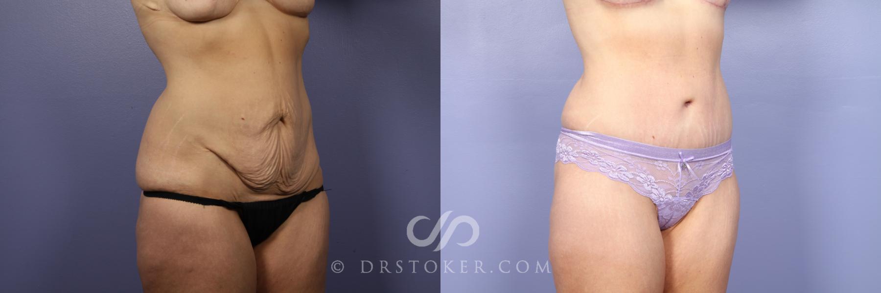 Before & After Tummy Tuck Case 440 View #2 View in Los Angeles, CA