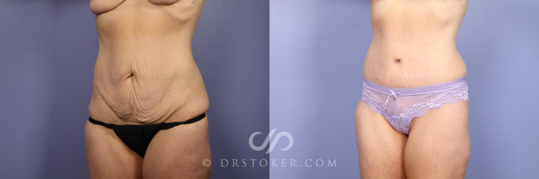Before & After Tummy Tuck Case 440 View #3 View in Los Angeles, CA