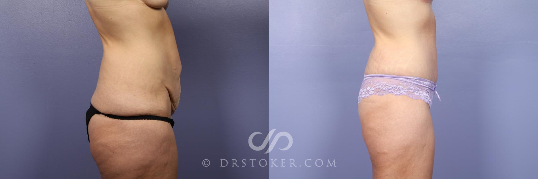 Before & After Tummy Tuck Case 440 View #4 View in Los Angeles, CA